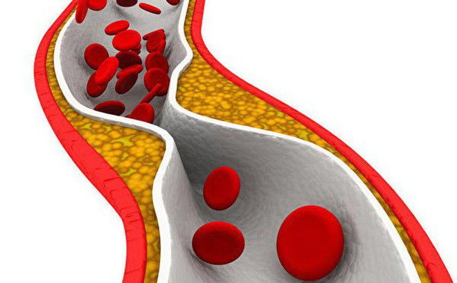 BS cảnh báo 4 dấu hiệu của chứng tắc mạch máu: Cần chú ý đề phòng tử vong bất ngờ - Ảnh 1.