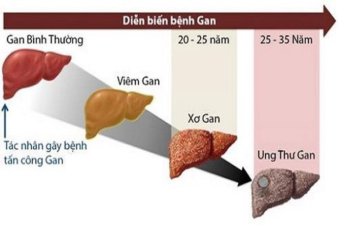 BS khuyên: 3 nhóm người nên đi khám gan sớm, chủ quan thì nguy cơ ung thư sẽ rất cao - Ảnh 2.