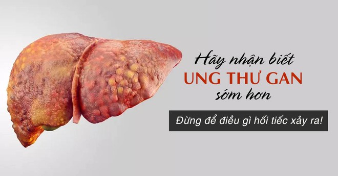 BS khuyên: 3 nhóm người nên đi khám gan sớm, chủ quan thì nguy cơ ung thư sẽ rất cao - Ảnh 3.