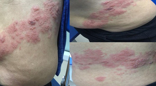 Căn bệnh ngoài da nhiều người chủ quan nhưng có thể gây ra biến hỏng mắt, dị tật thai nhi - Ảnh 1.