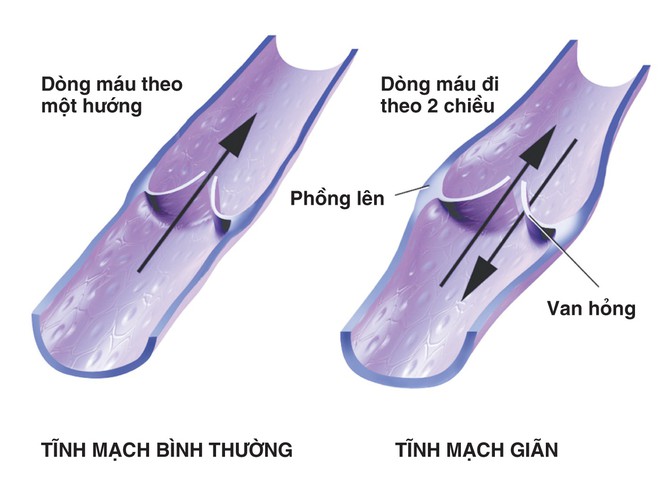 3 bệnh lý mạch máu nguy hiểm không thể bỏ sót - Ảnh 2.