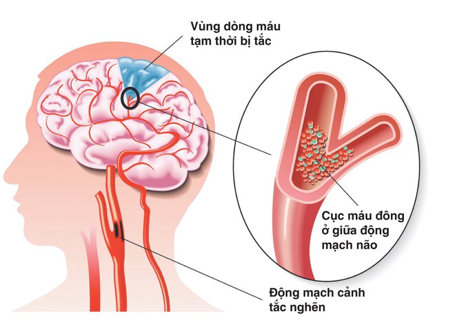 3 bệnh lý mạch máu nguy hiểm không thể bỏ sót - Ảnh 3.