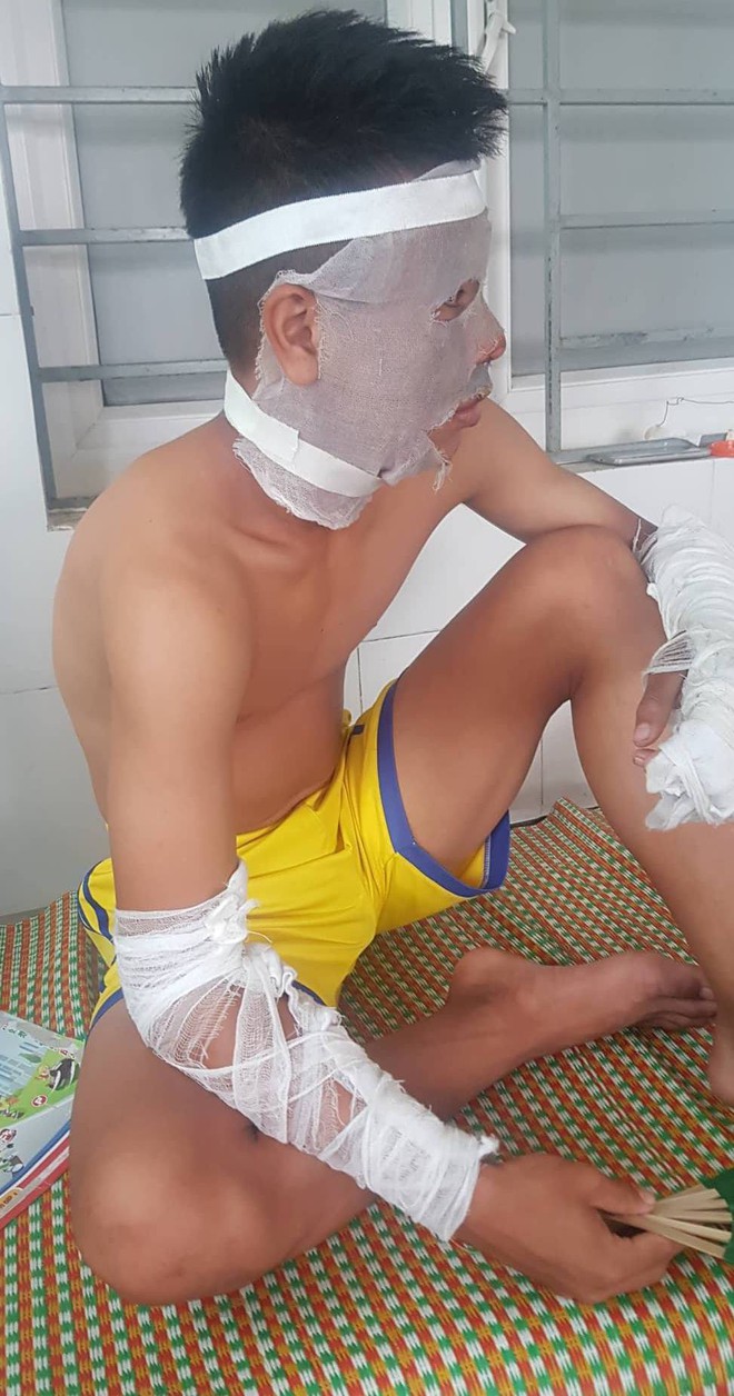 Nổ chùm bóng bay, 3 cầu thủ Sông Lam Nghệ An bị bỏng nặng - Ảnh 1.