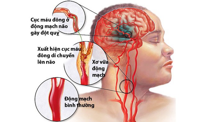 Bác sĩ cũng đột quỵ vì làm việc quá sức: Ai là người có nguy cơ cao? - Ảnh 2.