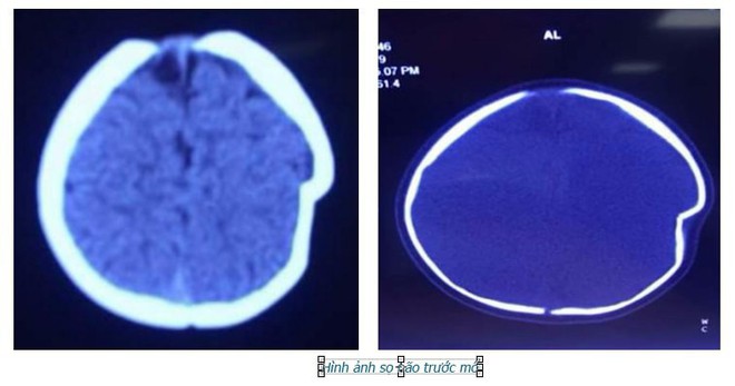 Ngã xe tập đi, bé 8 tháng tuổi ở Phú Thọ bị lún sọ não - Ảnh 1.