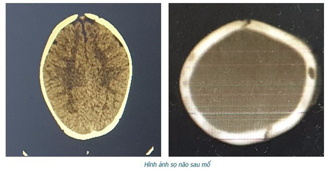 Ngã xe tập đi, bé 8 tháng tuổi ở Phú Thọ bị lún sọ não - Ảnh 2.