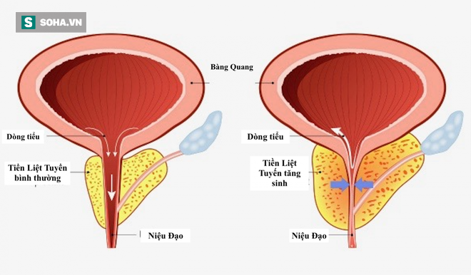 Nam giới sau tuổi 45 phải đặc biệt cảnh giác với 3 căn bệnh nguy hiểm: Biết muộn khó chữa - Ảnh 1.