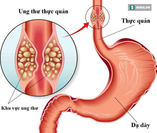 Ngất xỉu khi nghe BS báo tin bị mắc 2 bệnh ung thư cùng lúc: Ân hận vì 3 thói quen xấu - Ảnh 2.