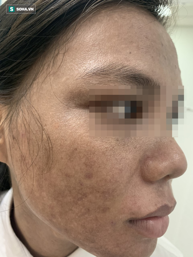 Khuôn mặt loang lổ của cô gái trẻ sau trị nám bằng kem trộn khiến nhiều người giật mình - Ảnh 1. Khuôn mặt loang lổ của cô gái trẻ sau trị nám bằng kem trộn khiến nhiều người giật mình - Ảnh 1.