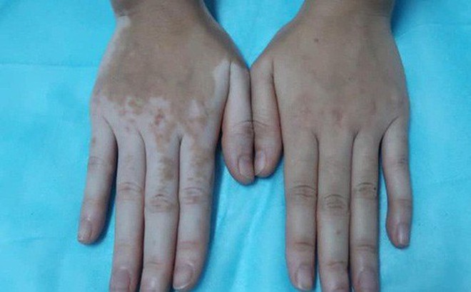 Cô gái bỗng đổi màu da tay, chân sau ngâm lá trầu không Cô gái bỗng đổi màu da tay, chân sau ngâm lá trầu không