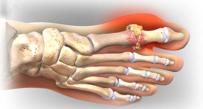 Chế độ ăn phòng bệnh trong ngày Tết cho những người mắc bệnh mạn tính - Ảnh 4.