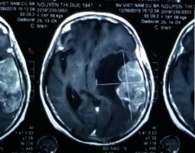 Phẫu thuật thành công khối u não “khủng” ở cụ bà 78 tuổi - Ảnh 1.