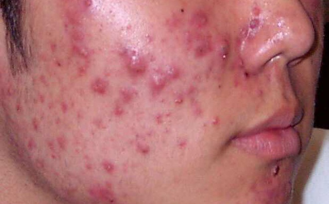 5 lý do khiến nhiều người thường xuyên bị mụn trứng cá: Làm 4 điều để không phá hỏng da 5 lý do khiến nhiều người thường xuyên bị mụn trứng cá: Làm 4 điều để không phá hỏng da