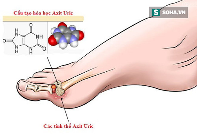 4 dấu hiệu xuất hiện trong khi ngủ cảnh báo axit uric quá cao: Đã đến lúc bạn cần đi khám - Ảnh 2.