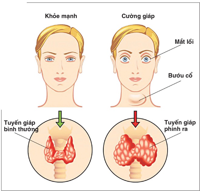 Thực phẩm thuốc trong điều trị bệnh cường giáp: Ăn uống đúng để giảm nhẹ bệnh tật - Ảnh 1.