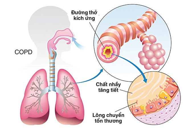 Phòng ngừa bệnh phổi tắc nghẽn mạn tính - Ảnh 1.