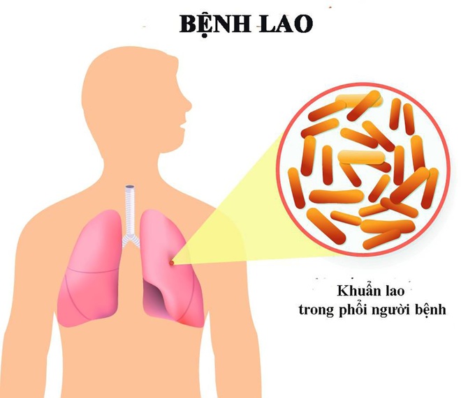 Các bệnh dễ nhầm với lao phổi - Ảnh 1.