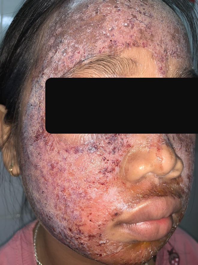 Thích trắng hồng, thiếu nữ 17 tuổi dùng kem lột cấp tốc khiến cả khuôn mặt bị phá nát - Ảnh 2.