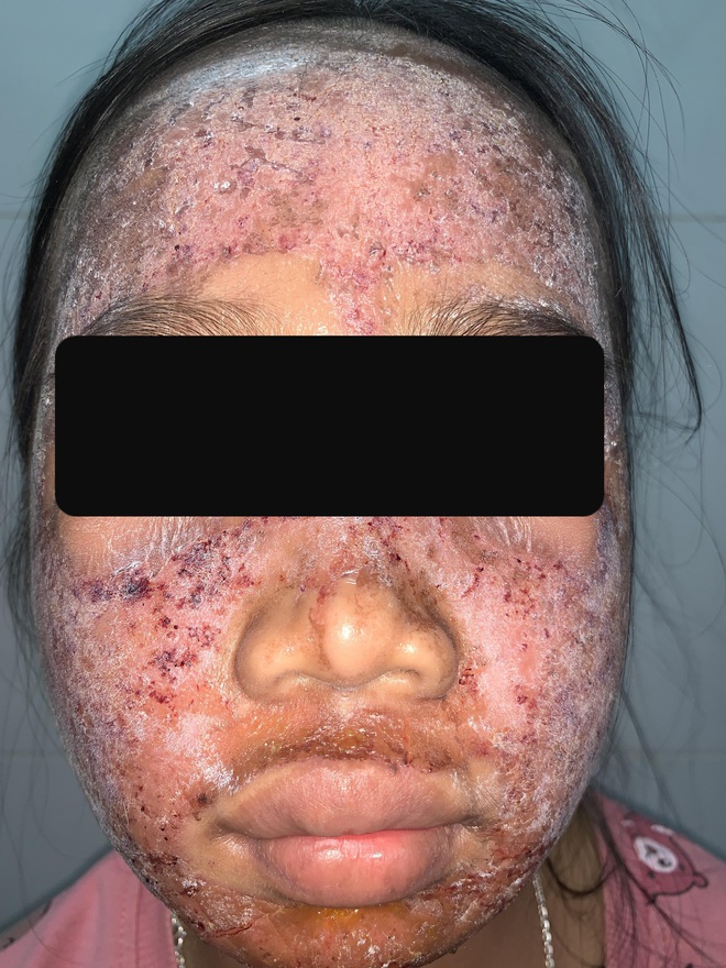 Thích trắng hồng, thiếu nữ 17 tuổi dùng kem lột cấp tốc khiến cả khuôn mặt bị phá nát - Ảnh 1.
