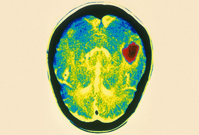 Phình động mạch não - bệnh lý nguy hiểm có thể gây tử vong - Ảnh 5.