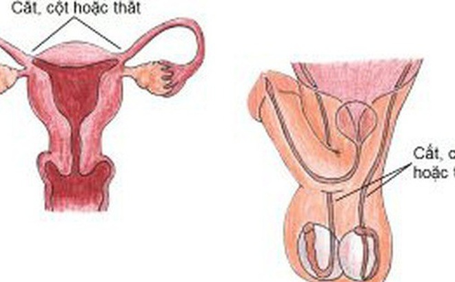 Vợ hay chồng đi triệt sản thì nhẹ nhàng hơn?