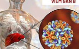 Nhiễm virus viêm gan B sau bao lâu xuất hiện triệu chứng và tiến triển thành ung thư gan?
