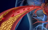 Bác sĩ tim mạch Mỹ: Dấu hiệu cảnh báo cholesterol tăng cao, có một cũng cần đi khám ngay