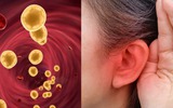 Khi mỡ máu tăng cao, tai sẽ phát ra 3 “tín hiệu” cảnh báo đỏ