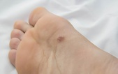 Có dấu hiệu lạ ở lòng bàn chân, người đàn ông làm ngay 1 việc: Được bác sĩ khen vì phát hiện ung thư sớm