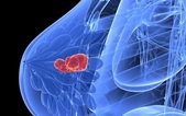 Chuyên gia ung thư khuyên nên tránh xa 4 tác nhân gây ung thư vú