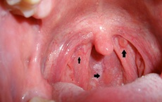 Sốc: 16 tuổi đã ung thư vòm họng, cha mẹ "chết đứng" khi phát hiện nguyên nhân do mình