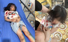 Bé 5 tuổi ở Hà Giang bị chó cắn nhập viện cấp cứu: Chủ chó phải chịu trách nhiệm như thế nào?