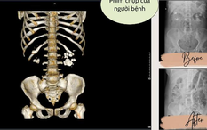 Xem phim chụp CT, bác sĩ “tá hỏa” khi thấy điều không ai ngờ trong thận người bệnh