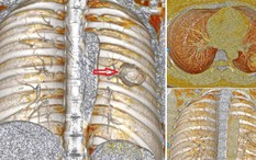 Xét nghiệm có chỉ số mang thai, cô gái ngỡ ngàng khi “thủ phạm” là ung thư tạo triệu chứng đánh lừa