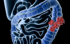 Muốn ngăn chặn ung thư đại tràng, đây là việc cần làm đầu tiên