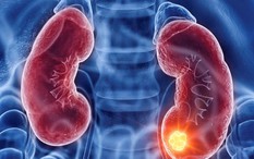 Ung thư thận dễ bị bỏ sót, chỉ phát hiện khi trong nước tiểu có máu