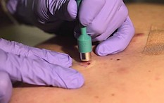 Chỉ vì 1 sai lầm, tế bào ác tính “ăn” mất 1 bên mắt: Bác sĩ cảnh báo dấu hiệu cần nghĩ tới ung thư