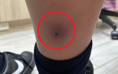 Tưởng chỉ là cúm mùa, bé trai 12 tuổi sốt trở lại: Bác sĩ vén ống quần kiểm tra liền yêu cầu cấp cứu khẩn cấp