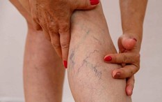 5 điều bác sĩ mạch máu nhắn nhủ bệnh nhân suy giãn tĩnh mạch ăn Tết vui khỏe, hạn chế gặp nhau trong bệnh viện