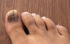 Dấu hiệu ở móng chân cảnh báo loại ung thư nguy hiểm: Nhiều người bỏ qua, bác sĩ khẩn thiết nhắc nhở