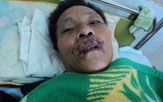 Bệnh nhân đầu tiên ở Bình Phước nhiễm liên cầu lợn