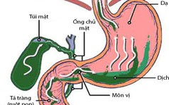 Khi có bệnh này phải chữa ngay kẻo ung thư "gõ cửa"