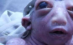 "Em bé ngoài hành tinh" sinh ra tại Ấn Độ