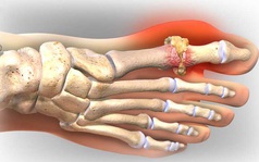 Lời khuyên bác sĩ: Chữa khỏi bệnh gout không phải thuốc, mà do bí quyết "ĂN ít, ỘP nhiều"