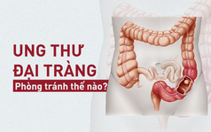 [Cẩm nang] 6 nguyên nhân gây ung thư đại tràng nhiều người Việt mắc mà không biết