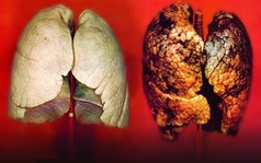 Khi gặp các dấu hiệu này, thì bệnh ung thư phổi cách bạn không còn bao xa