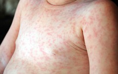 Đã mắc Rubella có mắc sởi nữa không?