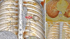 Xét nghiệm có chỉ số mang thai, cô gái ngỡ ngàng khi “thủ phạm” là ung thư tạo triệu chứng đánh lừa