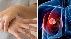 Ung thư phổi: 4 dấu hiệu bất thường xuất hiện ở tay, chân không nên chủ quan