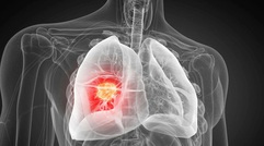 Phát hiện nguyên nhân gây ung thư phổi chưa từng biết